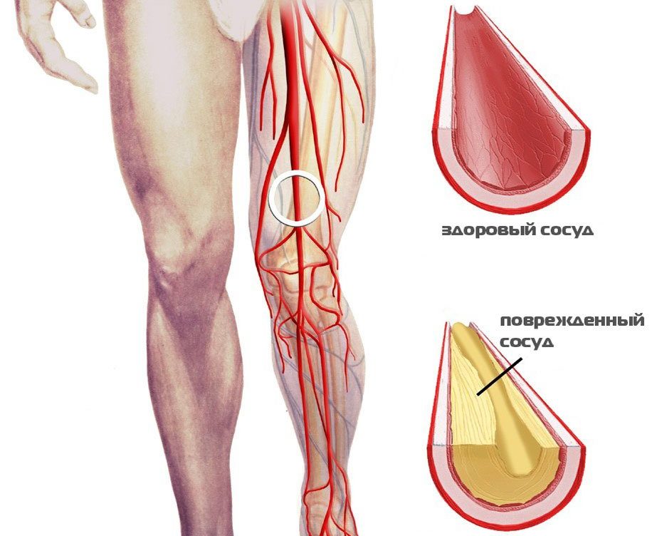 Тромбоз бедренных вен. Облитерирующий атеросклероз сосудов конечностей. Облитерирующий атеросклероз ног. Окклюзионных заболеваний артерий нижних конечностей. Тромбоз подколенной артерии.
