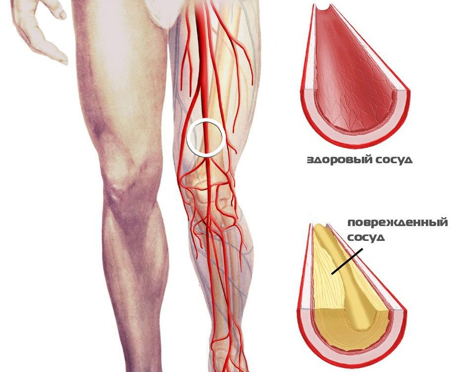 Сосуды заболевания лечение